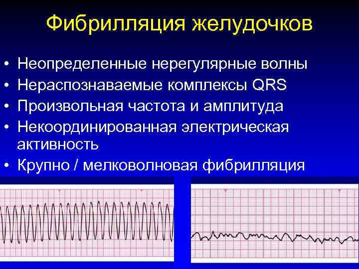 Фибрилляция желудочков • • Неопределенные нерегулярные волны Нераспознаваемые комплексы QRS Произвольная частота и амплитуда