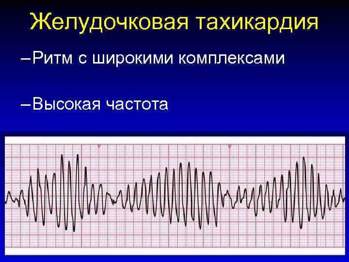 Желудочковая тахикардия – Ритм с широкими комплексами – Высокая частота RC (UK) 