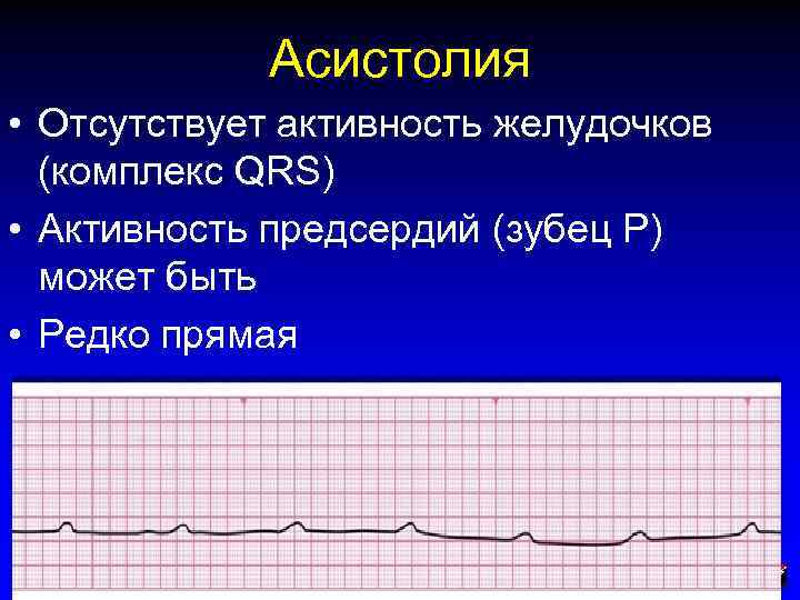 Асистолия • Отсутствует активность желудочков (комплекс QRS) • Активность предсердий (зубец P) может быть