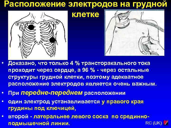 Расположение электродов на грудной клетке • Доказано, что только 4 % трансторакального тока проходит