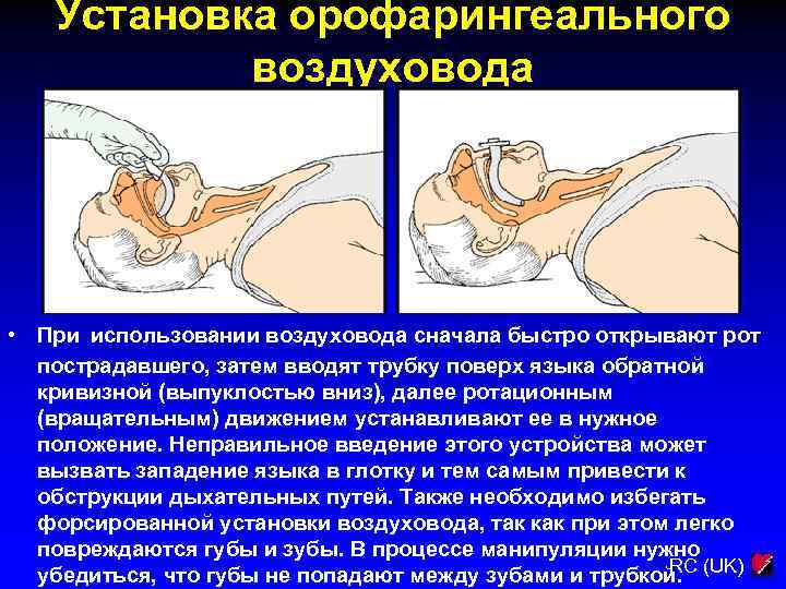 Установка орофарингеального воздуховода • При использовании воздуховода сначала быстро открывают рот пострадавшего, затем вводят