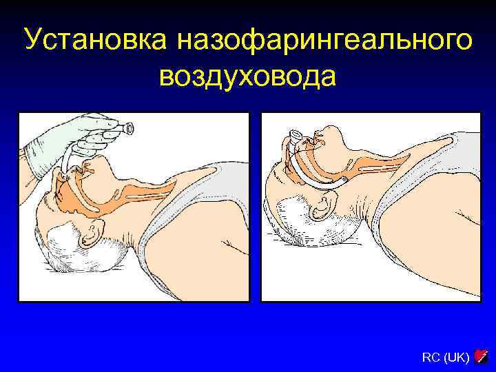 Установка назофарингеального воздуховода RC (UK) 