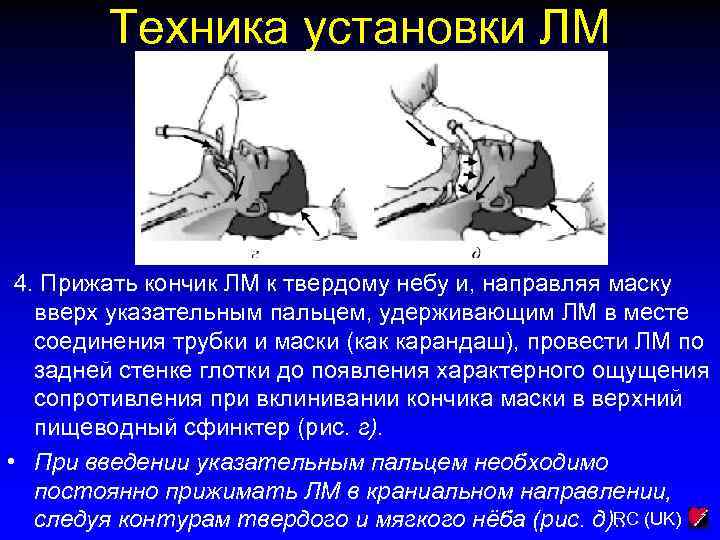 Техника установки ЛМ 4. Прижать кончик ЛМ к твердому небу и, направляя маску вверх