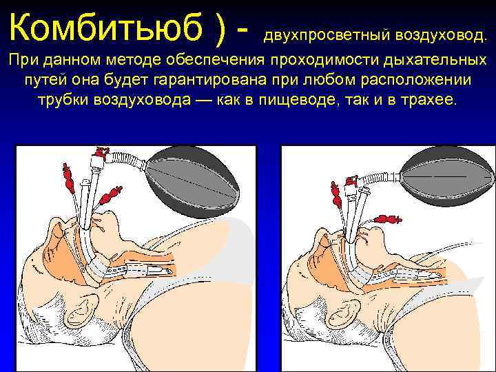 Комбитьюб ) - двухпросветный воздуховод. При данном методе обеспечения проходимости дыхательных путей она будет