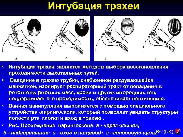 Интубация трахеи • Интубация трахеи является методом выбора восстановления проходимости дыхательных путей. • Введение