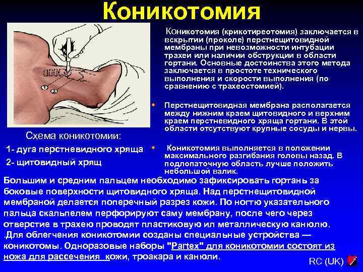 Коникотомия (крикотиреотомия) заключается в вскрытии (проколе) перстнещитовидной мембраны при невозможности интубации трахеи или наличии