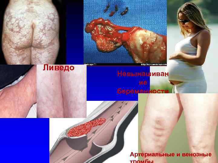 Ливедо Невынашиван ие беременности Артериальные и венозные RC (UK) 