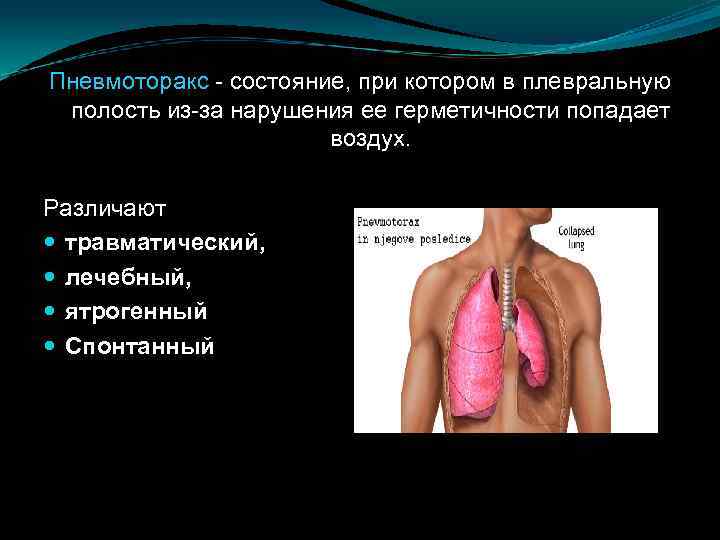 Пневмоторакс - состояние, при котором в плевральную полость из-за нарушения ее герметичности попадает воздух.