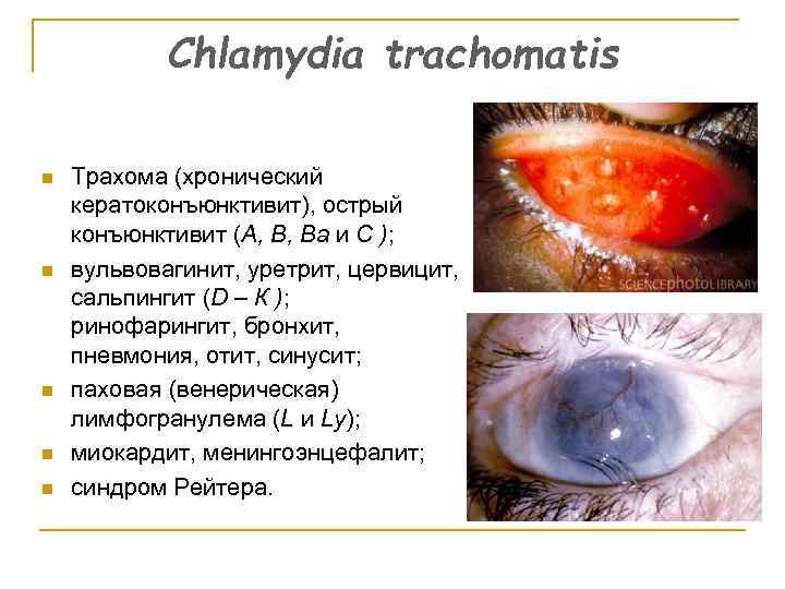 Chlamydia trachomatis n n n Трахома (хронический кератоконъюнктивит), острый конъюнктивит (А, В, Ва и