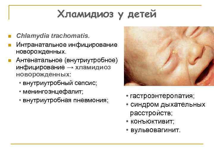 Хламидиоз у детей n n n Chlamydia trachomatis. Интранатальное инфицирование новорожденных. Антенатальное (внутриутробное) инфицирование