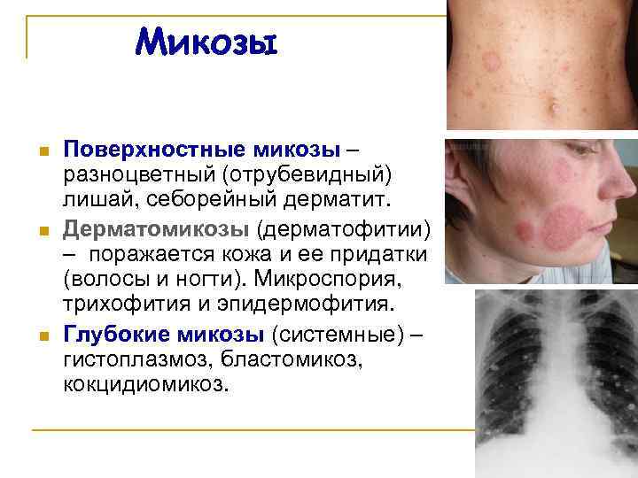Микозы n n n Поверхностные микозы – разноцветный (отрубевидный) лишай, себорейный дерматит. Дерматомикозы (дерматофитии)