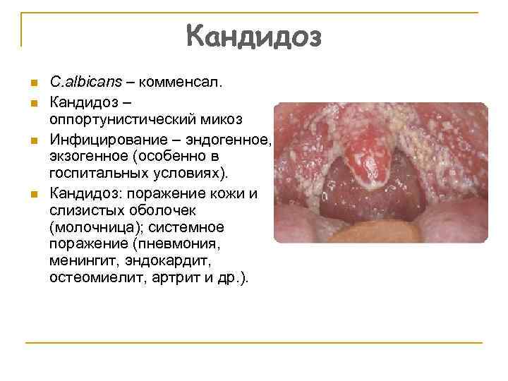 Кандидоз n n C. albicans – комменсал. Кандидоз – оппортунистический микоз Инфицирование – эндогенное,