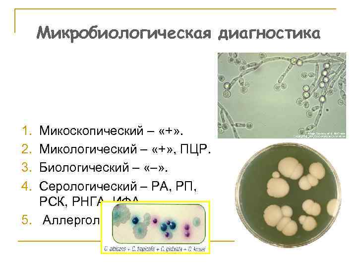 Микробиологическая диагностика 1. 2. 3. 4. Микоскопический – «+» . Микологический – «+» ,