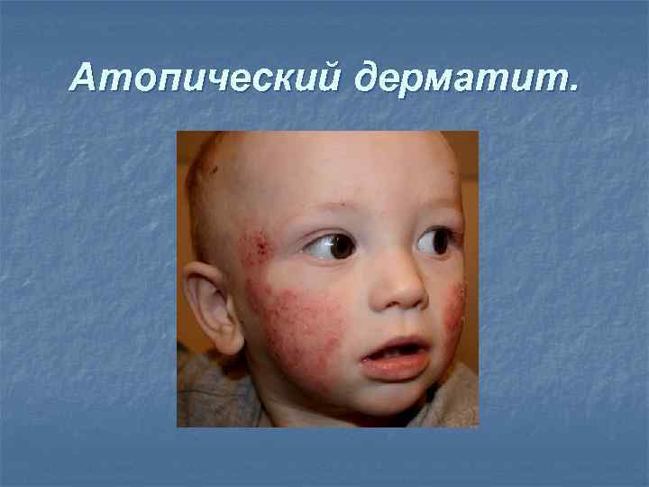 Атопический дерматит. 