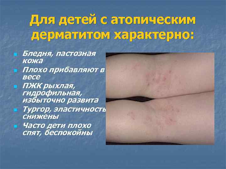 Для детей с атопическим дерматитом характерно: n n n Бледня, пастозная кожа Плохо прибавляют