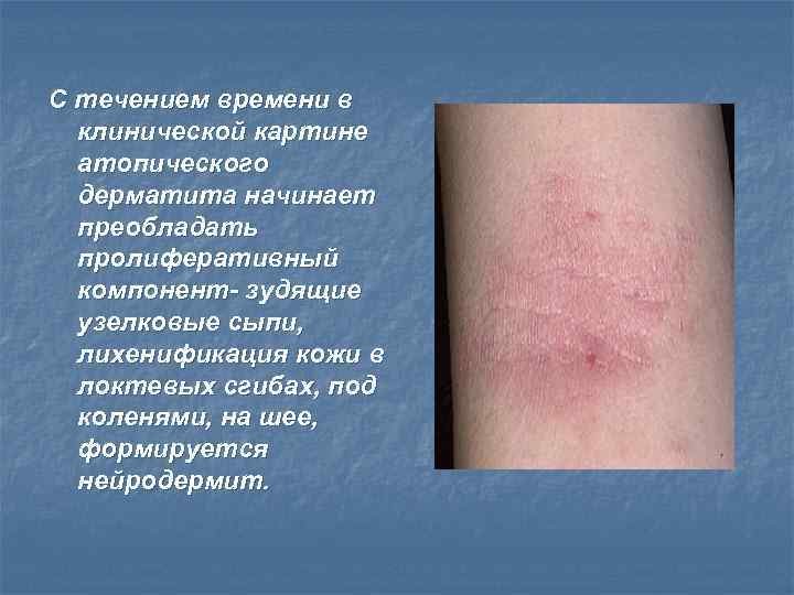 С течением времени в клинической картине атопического дерматита начинает преобладать пролиферативный компонент- зудящие узелковые