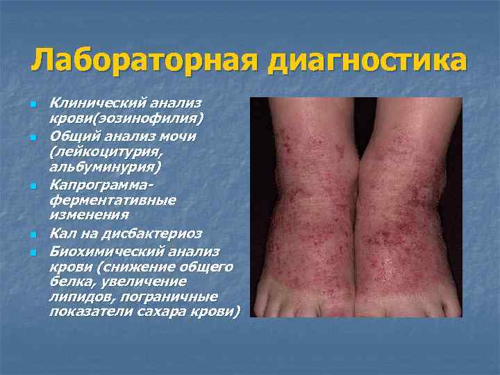 Лабораторная диагностика n n n Клинический анализ крови(эозинофилия) Общий анализ мочи (лейкоцитурия, альбуминурия) Капрограммаферментативные