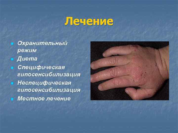 Лечение n n n Охранительный режим Диета Специфическая гипосенсибилизация Неспецифическая гипосенсибилизация Местное лечение 