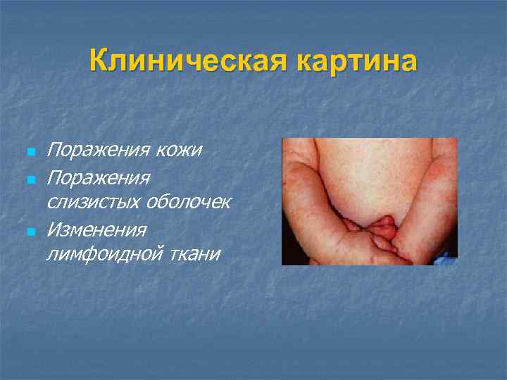 Клиническая картина n n n Поражения кожи Поражения слизистых оболочек Изменения лимфоидной ткани 