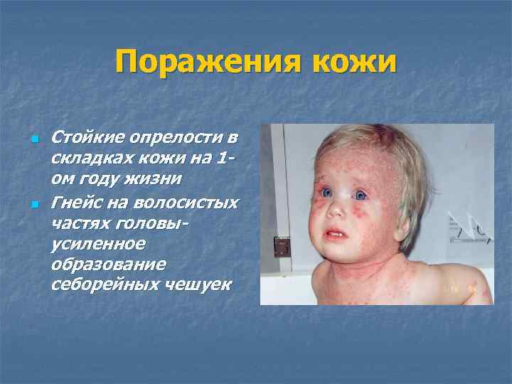 Поражения кожи n n Стойкие опрелости в складках кожи на 1 ом году жизни