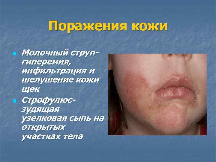 Поражения кожи n n Молочный струпгиперемия, инфильтрация и шелушение кожи щек Строфулюсзудящая узелковая сыпь