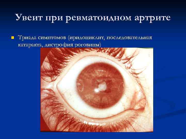 Увеит при ревматоидном артрите n Триада симптомов (иридоциклит, последовательная катаракта, дистрофия роговицы) 
