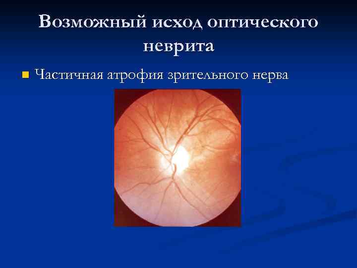Возможный исход оптического неврита n Частичная атрофия зрительного нерва 
