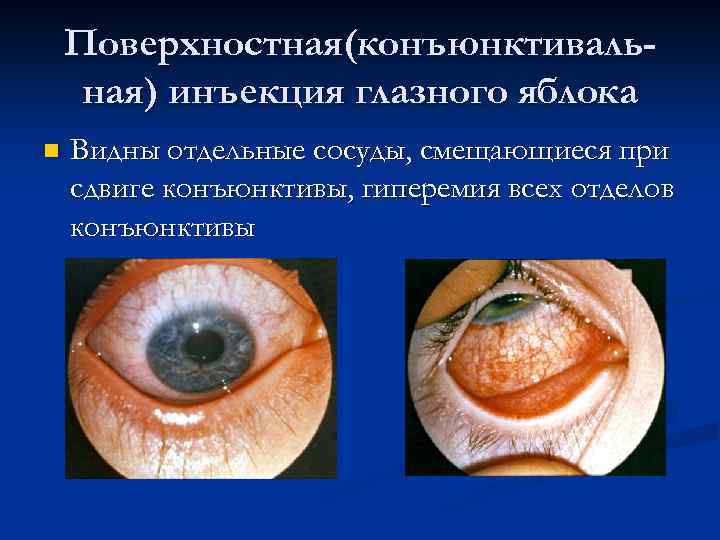 Поверхностная(конъюнктивальная) инъекция глазного яблока n Видны отдельные сосуды, смещающиеся при сдвиге конъюнктивы, гиперемия всех