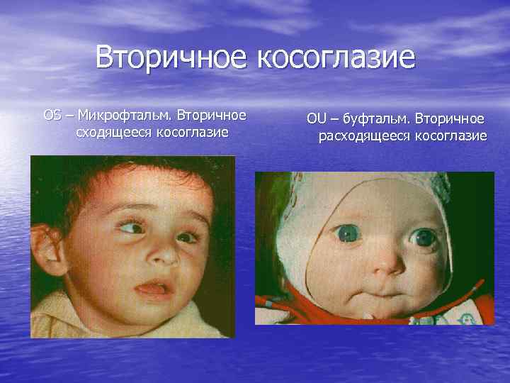 Вторичное косоглазие OS – Микрофтальм. Вторичное сходящееся косоглазие OU – буфтальм. Вторичное расходящееся косоглазие