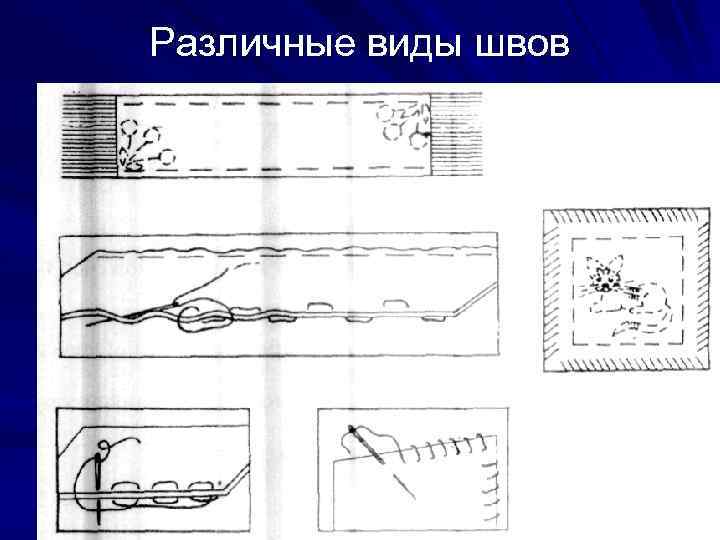 Различные виды швов 