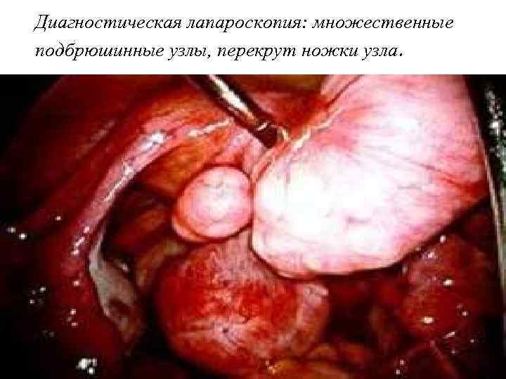 Диагностическая лапароскопия: множественные подбрюшинные узлы, перекрут ножки узла. 