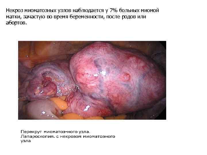 Некроз миоматозных узлов наблюдается у 7% больных миомой матки, зачастую во время беременности, после