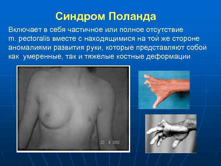 Синдром Поланда Включает в себя частичное или полное отсутствие m. pectoralis вместе с находящимися