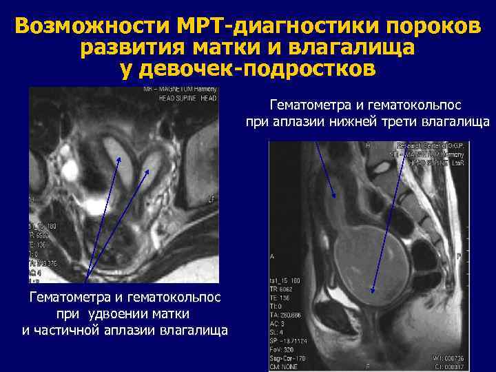 Выскабливание гематометры