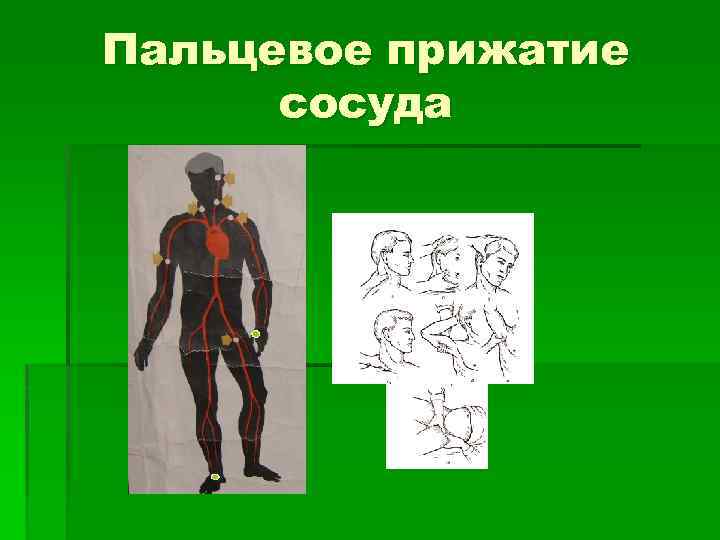 Пальцевое прижатие сосуда 