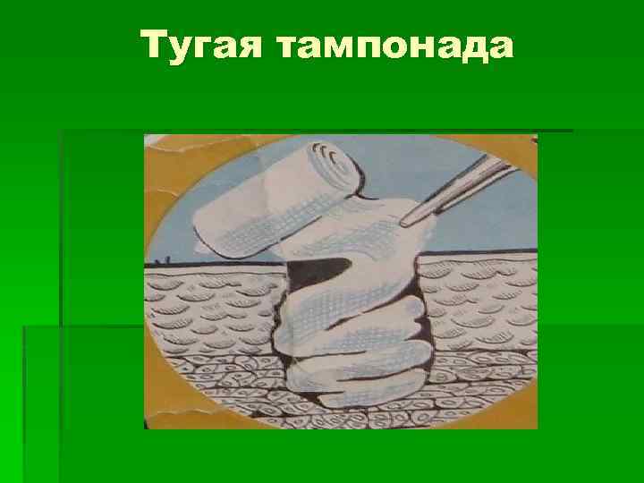 Тугая тампонада 