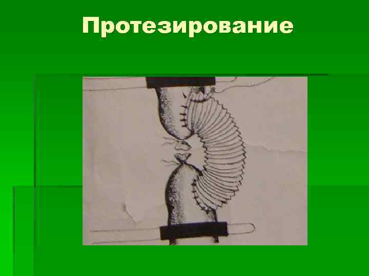 Протезирование 