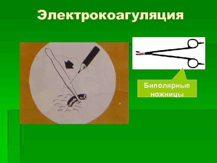 Электрокоагуляция Биполярные ножницы 