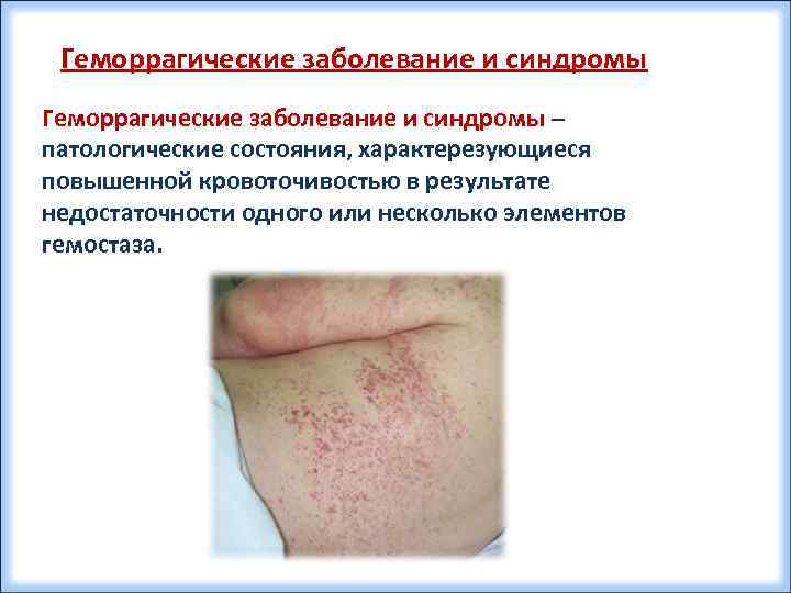 Геморрагические заболевание и синдромы – патологические состояния, характерезующиеся повышенной кровоточивостью в результате недостаточности одного