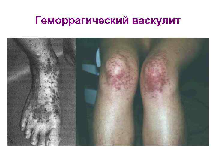 Геморрагический васкулит 
