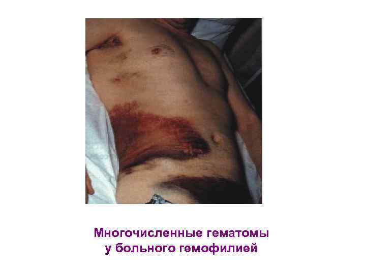 Многочисленные гематомы у больного гемофилией 