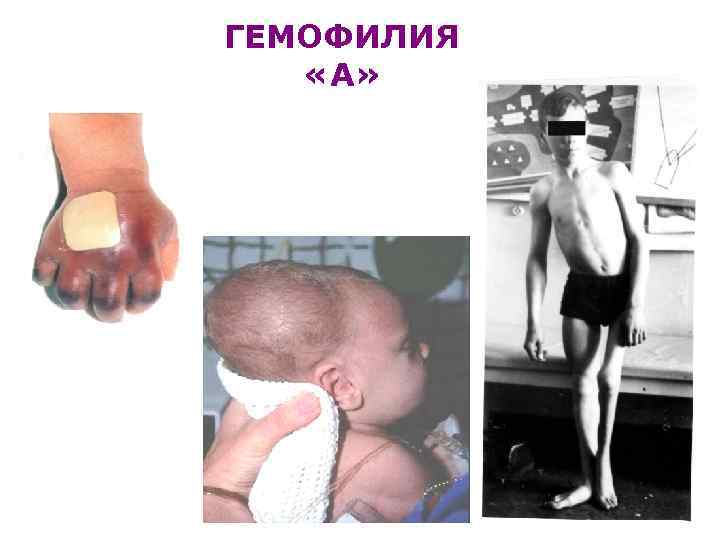 ГЕМОФИЛИЯ «А» 