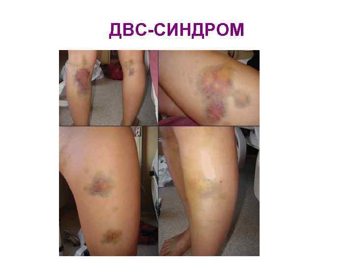 ДВС-СИНДРОМ 