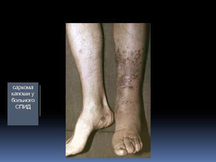 саркома капоши у больного СПИД 