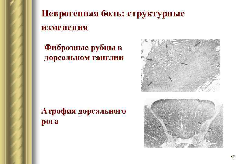 Неврогенная боль: структурные изменения Фиброзные рубцы в дорсальном ганглии Атрофия дорсального рога 67 