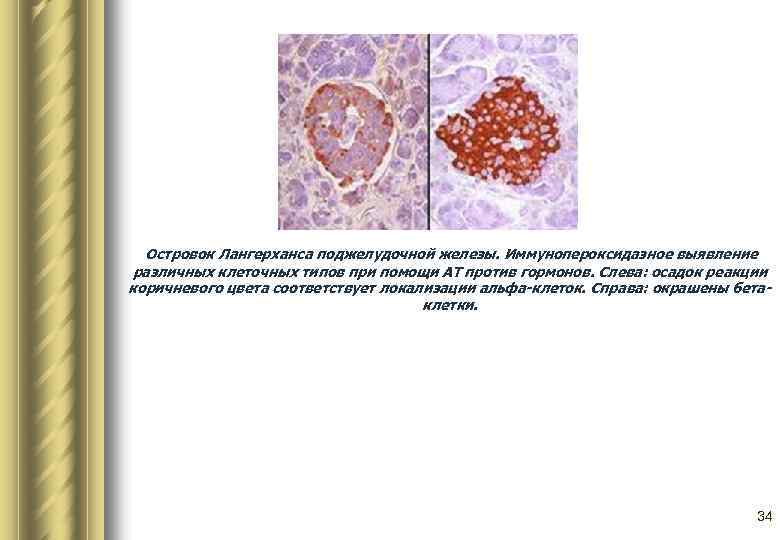  Островок Лангерханса поджелудочной железы. Иммунопероксидазное выявление различных клеточных типов при помощи АТ против