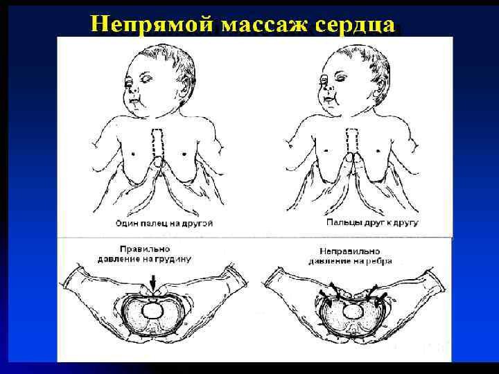 Массаж сердца новорожденным детям