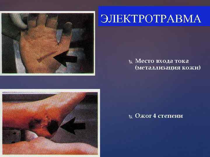 ЭЛЕКТРОТРАВМА Место входа тока (металлизация кожи) Ожог 4 степени 