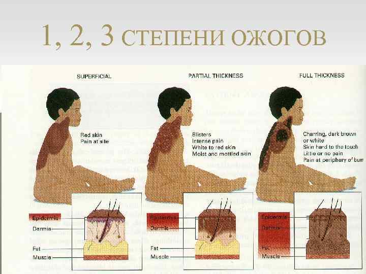 1, 2, 3 СТЕПЕНИ ОЖОГОВ 