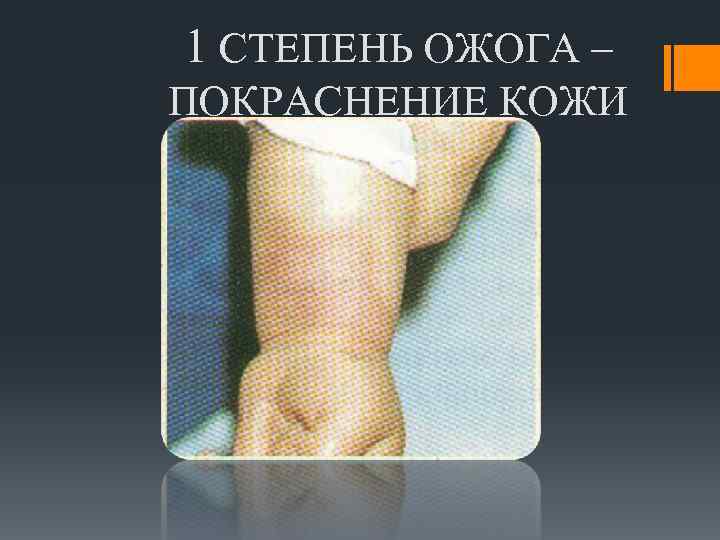 1 СТЕПЕНЬ ОЖОГА – ПОКРАСНЕНИЕ КОЖИ 
